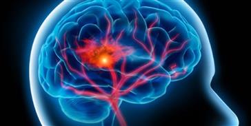 قاتلی که هر ۶ ثانیه یک قربانی می‌گیرد/بزرگترین مرکز استروک کشور در تبریز