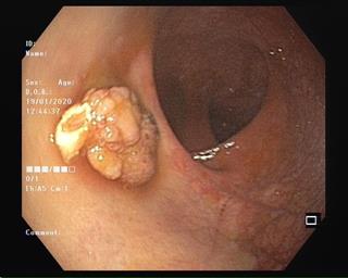 خارج کردن پولیپ بزرگ رکتومی به روش کلونوسکوپی
