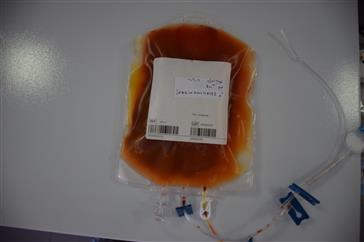 اهدا اولین مغز استخوان غیر خویشاوندی در تبریز