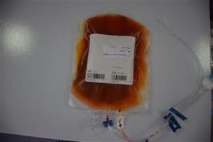 اهدا اولین مغز استخوان غیر خویشاوندی در تبریز